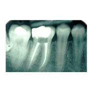 rootcanal1