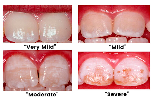 Micro abrasion & tooth bleaching