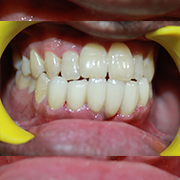 fix gaps in teeth in Bangalore